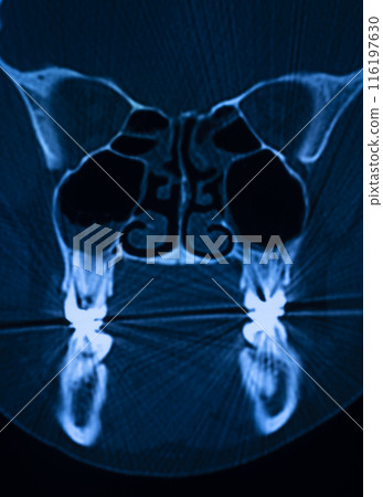 Xray scan skull nose Xray scan skull nose 116197630