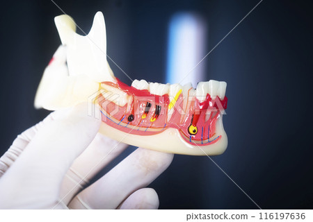 Tooth decay dental model Tooth decay dental model 116197636