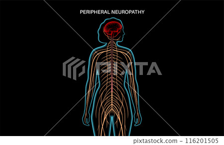 Peripheral neuropathy medical poster Peripheral neuropathy medical poster 116201505