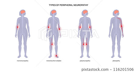Peripheral neuropathy medical poster 116201506