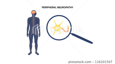 Peripheral neuropathy medical poster Peripheral neuropathy medical poster 116201507