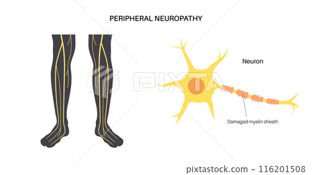 Peripheral neuropathy medical poster Peripheral neuropathy medical poster 116201508
