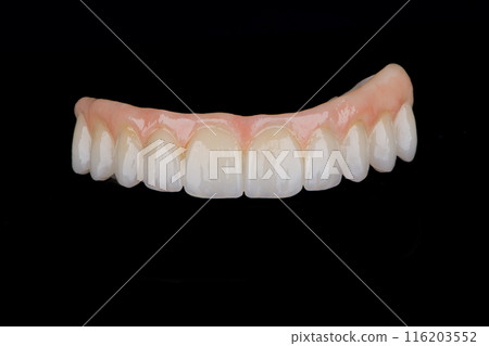 Two stages of making full dental zirkonium prosthesis on titanium bar. Raw before sintering and layered or painted zirkonium. 116203552