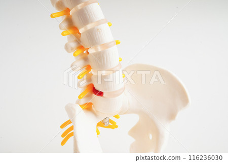 Spinal nerve and bone, Lumbar spine displaced herniated disc fragment, Model for treatment medical in the orthopedic department. 116236030