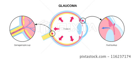 Glaucoma eye disease 116237174