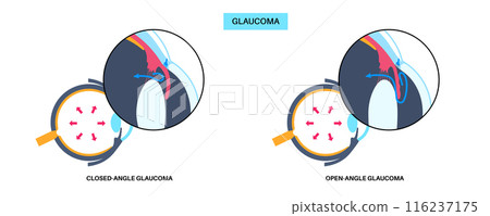 Glaucoma eye disease 116237175