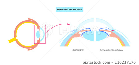 Glaucoma eye disease 116237176