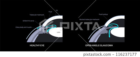 Glaucoma eye disease Glaucoma eye disease 116237177