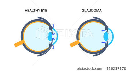 Glaucoma eye disease 116237178