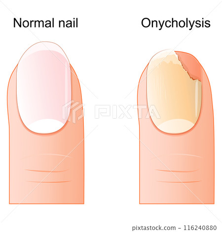 Onycholysis. detachment of the nail plate Onycholysis. detachment of the nail plate 116240880