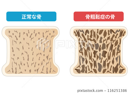 Comparison of cross sections of osteoporotic and normal bones 116251386