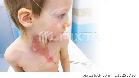 dressing a boy with a burn from boiling water dressing a boy with a burn from boiling water 116253756