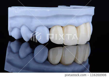 High-quality naturally dental single crowns made of zirconium for fixation to the frontal teeth of upper jaw. High-quality naturally dental single crowns made of zirconium for fixation to the frontal teeth of upper jaw. 116268906