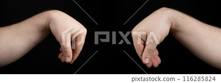 Comparison of healthy arm and arm with wrist ganglion cyst on black background. 116285824