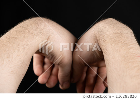 Comparison of healthy arm and arm with wrist ganglion cyst. 116285826