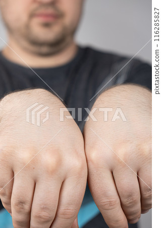 Comparison of healthy arm and arm with wrist ganglion cyst. 116285827