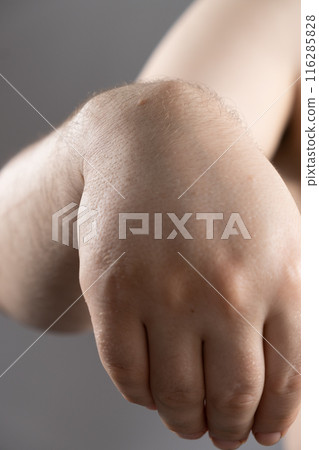 Ganglion cyst or hygroma of the wrist on the hand of a male patient Ganglion cyst or hygroma of the wrist on the hand of a male patient 116285828