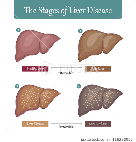 Stages of Liver Damage flat vector illustration. 116288092