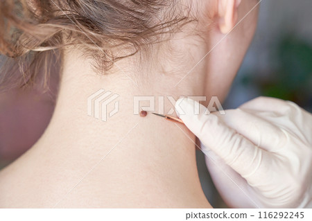 Woman examing her abnormal mole. Dermatology procedure. Doctor checking Woman examing her abnormal mole. Dermatology procedure. Doctor checking 116292245