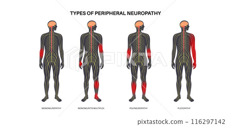 Peripheral neuropathy medical poster Peripheral neuropathy medical poster 116297142