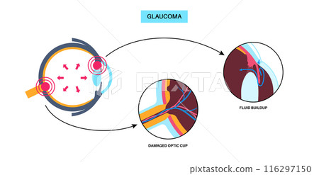 Glaucoma eye disease 116297150