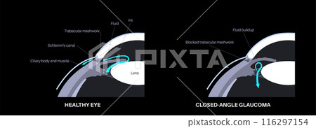 Glaucoma eye disease 116297154