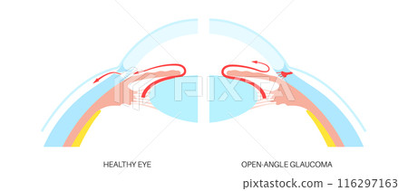 Glaucoma eye disease 116297163