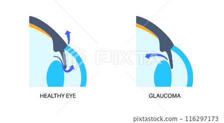 Glaucoma eye disease Glaucoma eye disease 116297173