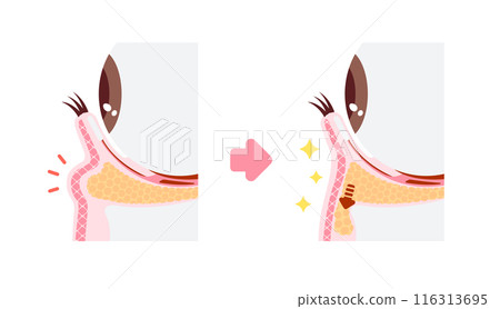 Illustrations of surgery to remove dark circles under the eyes (Hamra method, Ura Hamra method) 116313695