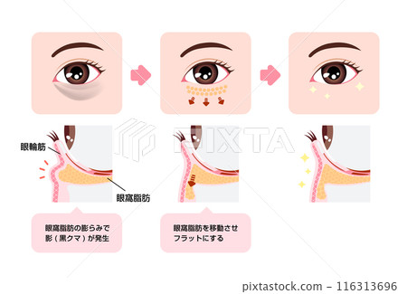 Illustrations of surgery to remove dark circles under the eyes (Hamra method, Ura Hamra method) Illustrations of surgery to remove dark circles under the eyes (Hamra method, Ura Hamra method) 116313696