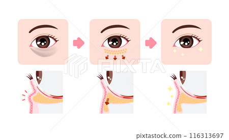 眼圈(黑熊)去除手術圖解(哈姆拉法/烏拉哈姆拉法) 眼圈(黑熊)去除手術圖解(哈姆拉法/烏拉哈姆拉法) 116313697