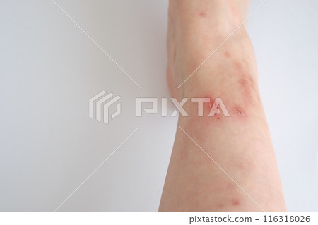 40多歲女人右腳結痂 116318026