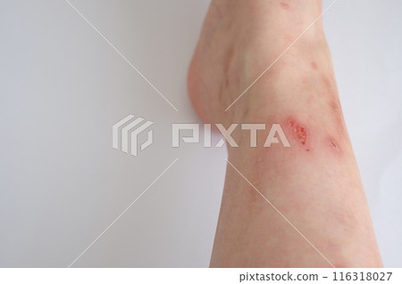 40多歲女人右腳結痂 116318027