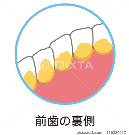 Plaque accumulated on the back of the front teeth, toothbrushing, unbrushed areas 116320037