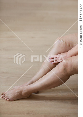 The woman rubs tired legs with a special cream to reduce pain. Phlebology. Painful varicose and spider veins on active female legs, medicine and health. The woman rubs tired legs with a special cream to reduce pain. Phlebology. Painful varicose and spider veins on active female legs, medicine and health. 116325522