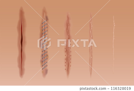 Set of healing wounds, skin scars, stitched gash and cuts. Realistic surgical sutures, stitched wounds at different healing stages isolated on human skin background Set of healing wounds, skin scars, stitched gash and cuts. Realistic surgical sutures, stitched wounds at different healing stages isolated on human skin background 116328019