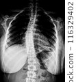 X-ray of idiopathic scoliosis of thoracic spine. Part of adolescent skeleton with spinal curvature on black background. Lateral backbone deformation. Radiological anatomy image 116329402
