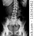 X-ray of idiopathic scoliosis of lumbar spine. Part of adolescent skeleton with spinal curvature on black background. Lateral backbone bending. Radiological anatomy image of lower back and pelvis 116341462