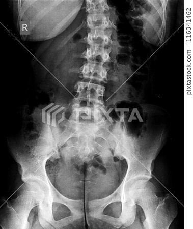 X-ray of idiopathic scoliosis of lumbar spine. Part of adolescent skeleton with spinal curvature on black background. Lateral backbone bending. Radiological anatomy image of lower back and pelvis X-ray of idiopathic scoliosis of lumbar spine. Part of adolescent skeleton with spinal curvature on black background. Lateral backbone bending. Radiological anatomy image of lower back and pelvis 116341462