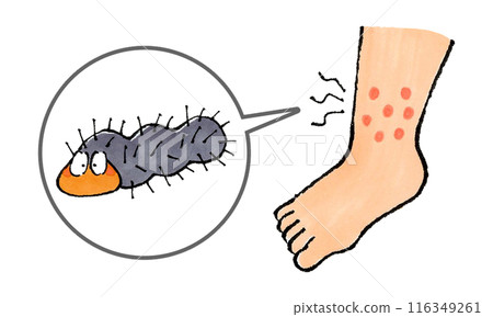 腳被毛毛蟲咬了 116349261
