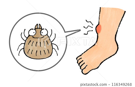 腿被蜱蟲咬了 116349268