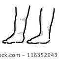 Swelling, swollen feet, swollen legs, sock marks, monochrome 116352943