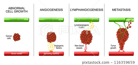 Cancer. Tumor development. Angiogenesis and Metastasis. 116359659