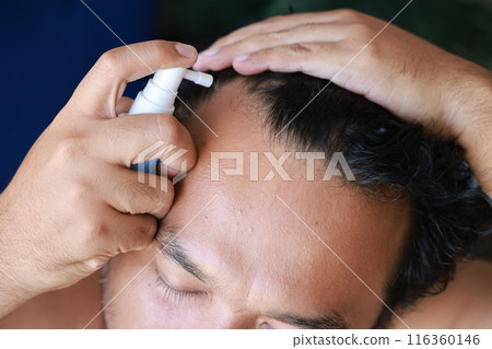 Asian men use serum spray to maintain strong hair and prevent breakage. Man with worry and touching on his head to show a bald head. Hair root nourishment. concept of healthcare, treat, medicine. 116360146