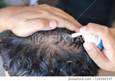 Asian men use serum spray to maintain strong hair and prevent breakage. Man with worry and touching on his head to show a bald head. Hair root nourishment. concept of healthcare, treat, medicine. Asian men use serum spray to maintain strong hair and prevent breakage. Man with worry and touching on his head to show a bald head. Hair root nourishment. concept of healthcare, treat, medicine. 116360147