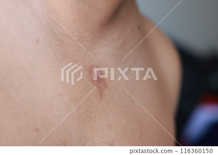 Asian man has blisters on his chest from oil splashes while cooking. Pityriasis rosea disease on the chest and neck on an isolated background. concept of healthcare, treat, medicine, injured. 116360150