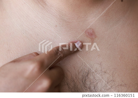 Asian man has blisters on his chest from oil splashes while cooking. Pityriasis rosea disease on the chest and neck on an isolated background. concept of healthcare, treat, medicine, injured. 116360151