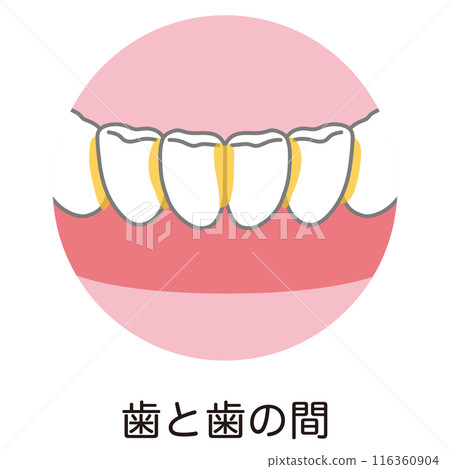Plaque accumulated between teeth, tooth brushing, brushing residue Plaque accumulated between teeth, tooth brushing, brushing residue 116360904