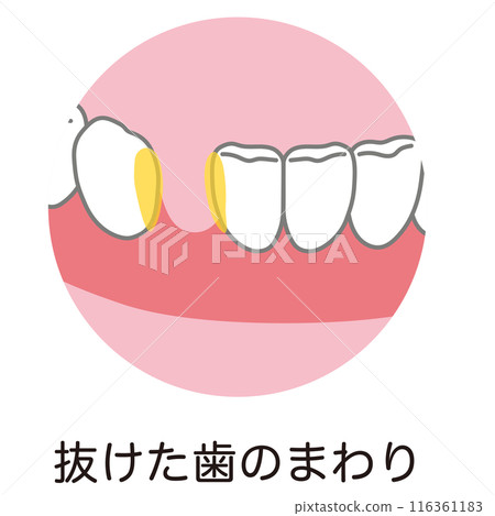 Plaque accumulated around the lost tooth Toothbrushing 116361183