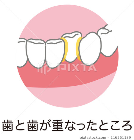 Plaque that has accumulated between teeth, tooth brushing, unbrushed areas 116361189